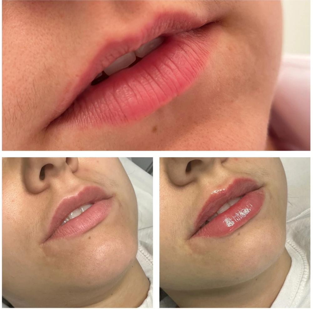 Lib treatment result