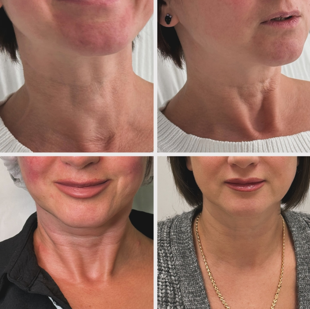 Neck treatment result